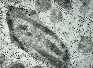 M,15y. | Wilson disease - megamitochondria M,15y. | Wilson disease - megamitochondria